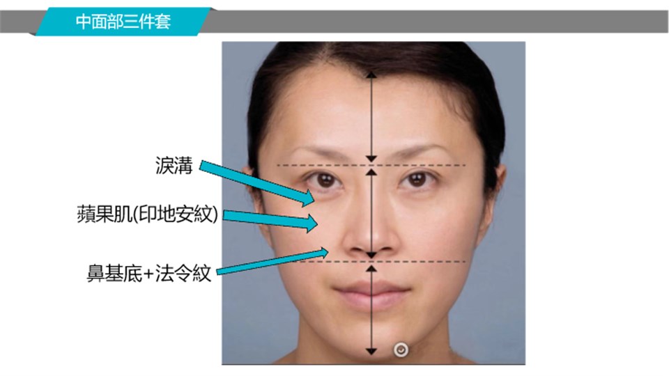 眼周與中面部銜接案例
