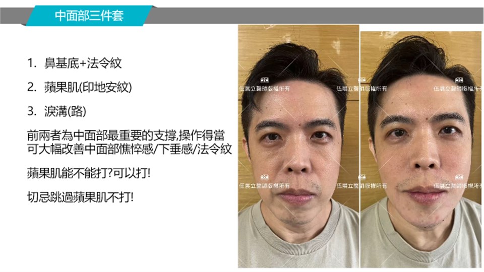 中面部三件套支撐案例