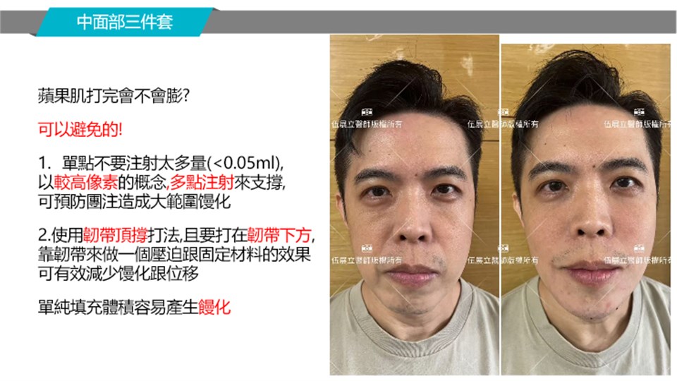 蘋果肌分點支撐案例