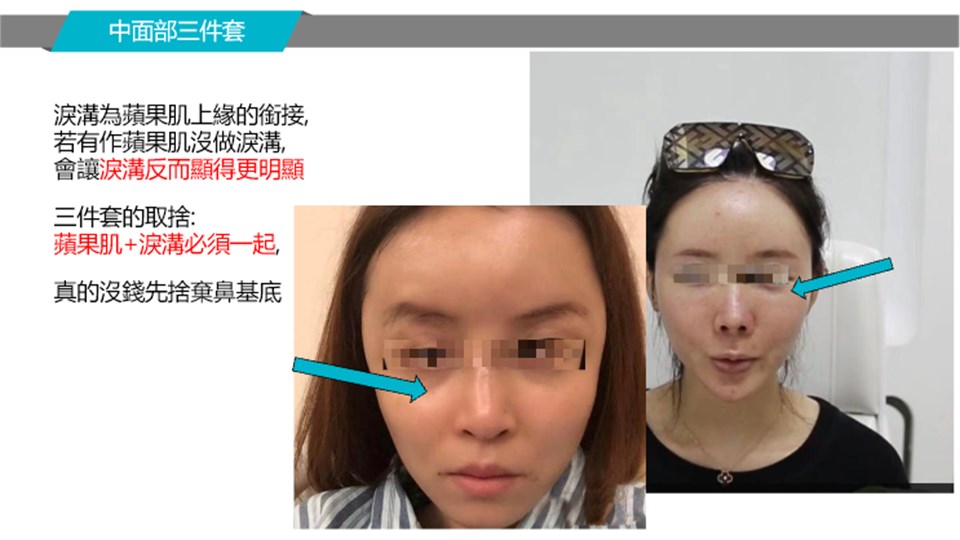 淚溝與蘋果肌銜接案例