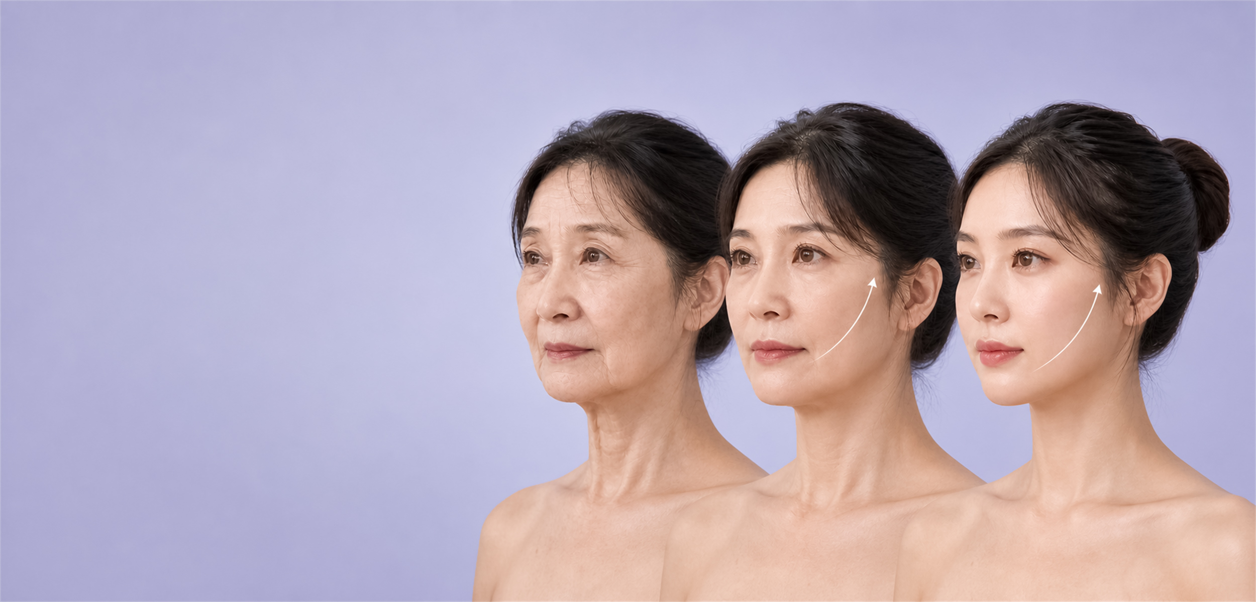 三種年齡層的臉部拉提美學示意
