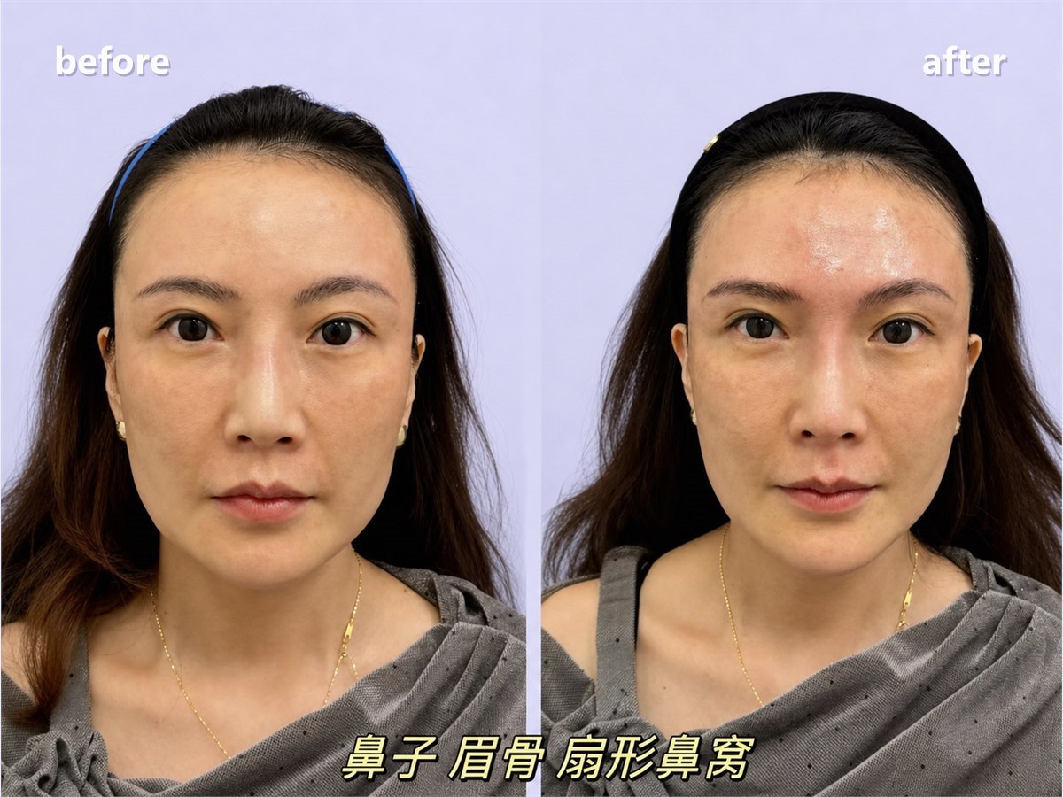 下頷角綜合治療方案示意